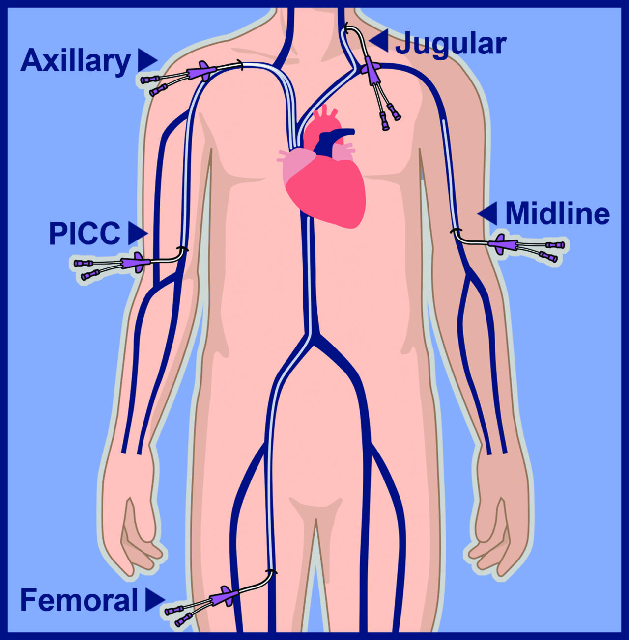 Peripheral Central Venous Catheter Induced Supraventricular Tachycardia